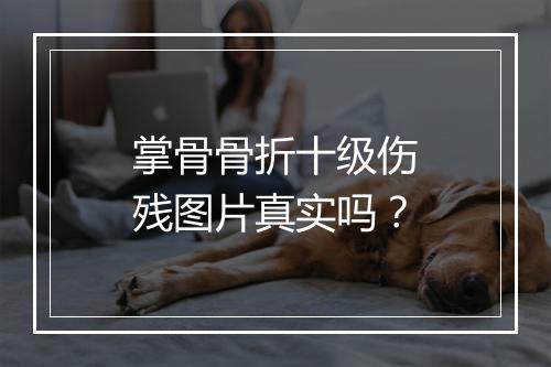 掌骨骨折十级伤残图片真实吗？