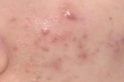 痘痘变成硬硬的鼓包怎么去除 痘痘变成硬硬的鼓包图片