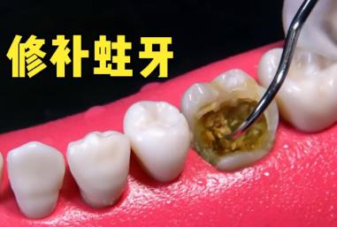 “10岁娃用牙洞修复牙膏后损失6颗牙”火的原因医生说出了真相