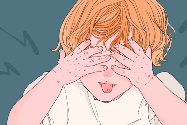 手足口病是怎么引起的 怎么预防手口足病